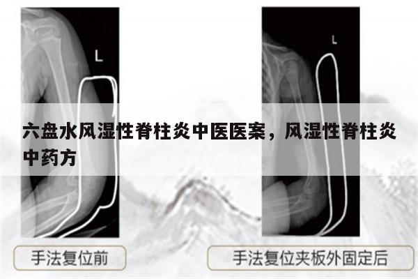 六盘水风湿性脊柱炎中医医案,风湿性脊柱炎中药方